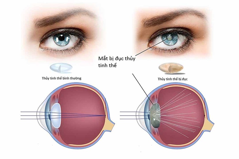 Dấu Hiệu Nhận Biết Bệnh Đục Thủy Tinh Thể Và Phương Pháp Điều Trị Hiệu Quả ?